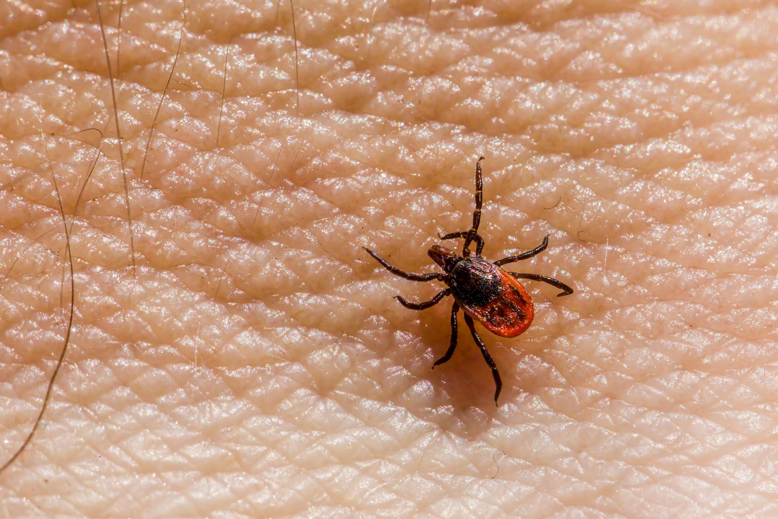 Lyme Disease